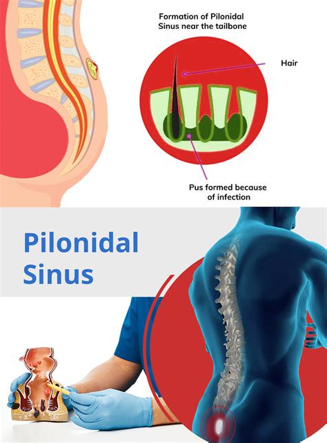 Treatment involves drainage and surgical removal of. . Does everyone have a pilonidal sinus